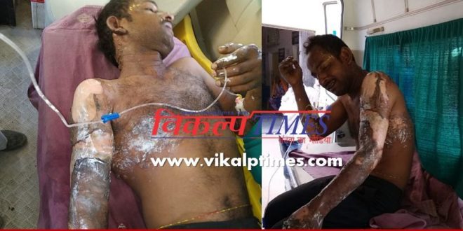 Cylinder scorching young man burn youth