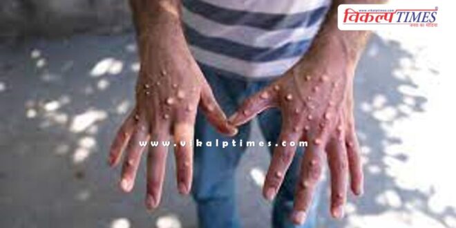 Indian government alert from monkeypox virus