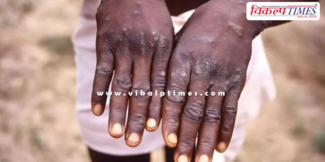 First case of MPox virus, Central Government confirms in india